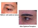 Click image for larger version

Name:	Hair Transplant Slides eyebrows.121.jpg
Views:	561
Size:	58.9 KB
ID:	466492