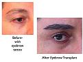 Click image for larger version

Name:	Hair Transplant Slides eyebrows.122.jpg
Views:	1112
Size:	66.8 KB
ID:	466493