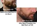 Click image for larger version

Name:	Hair Transplant Slides beard.123.jpg
Views:	323
Size:	69.0 KB
ID:	466521