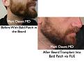 Click image for larger version

Name:	Hair Transplant Slides beard.123.jpg
Views:	385
Size:	69.0 KB
ID:	466521