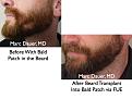 Click image for larger version

Name:	Hair Transplant Slides beard.124.jpg
Views:	278
Size:	76.5 KB
ID:	466522