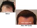 Click image for larger version

Name:	Hair Transplant Slides5.124.jpg
Views:	458
Size:	54.8 KB
ID:	466523
