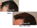 Click image for larger version

Name:	Hair Transplant Slides5.125.jpg
Views:	356
Size:	56.2 KB
ID:	466524