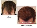Click image for larger version

Name:	Hair Transplant Slides5.127.jpg
Views:	788
Size:	66.5 KB
ID:	466526