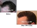 Click image for larger version

Name:	Hair Transplant Slides5.130.jpg
Views:	348
Size:	56.4 KB
ID:	466528