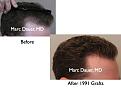 Click image for larger version

Name:	Hair Transplant Slides5.131.jpg
Views:	343
Size:	56.3 KB
ID:	466529