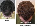 Click image for larger version

Name:	Hair Transplant Slides5.132.jpg
Views:	356
Size:	87.2 KB
ID:	466530