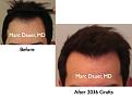 Click image for larger version

Name:	Hair Transplant Slides.133.jpg
Views:	418
Size:	51.8 KB
ID:	466550