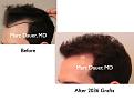 Click image for larger version

Name:	Hair Transplant Slides.134.jpg
Views:	379
Size:	50.2 KB
ID:	466551