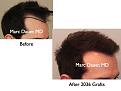 Click image for larger version

Name:	Hair Transplant Slides.135.jpg
Views:	378
Size:	54.4 KB
ID:	466552