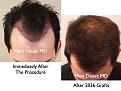 Click image for larger version

Name:	Hair Transplant Slides.136.jpg
Views:	382
Size:	78.6 KB
ID:	466553