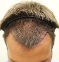 Click image for larger version

Name:	pre-op pics (37).jpg
Views:	822
Size:	80.1 KB
ID:	466657