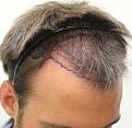 Click image for larger version

Name:	pre-op pics (41).jpg
Views:	585
Size:	81.2 KB
ID:	466659