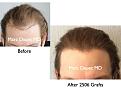 Click image for larger version

Name:	Hair Transplant Slides3.140.jpg
Views:	420
Size:	62.9 KB
ID:	466702