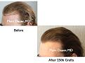 Click image for larger version

Name:	Hair Transplant Slides3.142.jpg
Views:	418
Size:	60.6 KB
ID:	466704