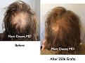 Click image for larger version

Name:	Hair Transplant Slides3.144.jpg
Views:	391
Size:	92.0 KB
ID:	466706