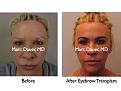 Click image for larger version

Name:	Hair Transplant Slides9.145.jpg
Views:	592
Size:	56.8 KB
ID:	466707