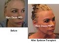 Click image for larger version

Name:	Hair Transplant Slides9.146.jpg
Views:	546
Size:	61.0 KB
ID:	466708
