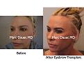 Click image for larger version

Name:	Hair Transplant Slides9.147.jpg
Views:	419
Size:	58.0 KB
ID:	466709