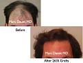 Click image for larger version

Name:	Hair Transplant Slides3.149.jpg
Views:	314
Size:	57.2 KB
ID:	466758