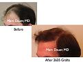 Click image for larger version

Name:	Hair Transplant Slides3.150.jpg
Views:	227
Size:	54.5 KB
ID:	466759