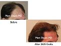 Click image for larger version

Name:	Hair Transplant Slides3.151.jpg
Views:	228
Size:	51.5 KB
ID:	466760