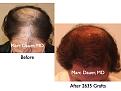 Click image for larger version

Name:	Hair Transplant Slides3.152.jpg
Views:	302
Size:	66.7 KB
ID:	466761
