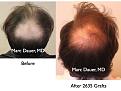 Click image for larger version

Name:	Hair Transplant Slides3.153.jpg
Views:	295
Size:	78.9 KB
ID:	466762