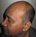 Click image for larger version

Name:	Darling Buds hair transplant Chandigarh India (4).JPG
Views:	357
Size:	43.5 KB
ID:	466790