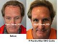 Click image for larger version

Name:	Hair Transplant Slides5.160.jpg
Views:	299
Size:	87.5 KB
ID:	466940