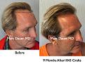 Click image for larger version

Name:	Hair Transplant Slides5.162.jpg
Views:	293
Size:	90.2 KB
ID:	466942