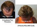 Click image for larger version

Name:	Hair Transplant Slides2.163.jpg
Views:	296
Size:	79.6 KB
ID:	466943