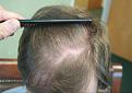 Click image for larger version

Name:	CH 1 Yr Post OP TOPa.jpg
Views:	1501
Size:	68.9 KB
ID:	467090