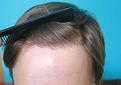 Click image for larger version

Name:	CH 1 YR Post op LTb.jpg
Views:	1185
Size:	57.6 KB
ID:	467097