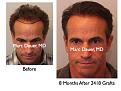 Click image for larger version

Name:	Hair Transplant Slides3.165.jpg
Views:	246
Size:	71.9 KB
ID:	467259