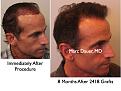 Click image for larger version

Name:	Hair Transplant Slides3.167.jpg
Views:	315
Size:	76.0 KB
ID:	467260