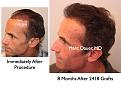 Click image for larger version

Name:	Hair Transplant Slides3.166.jpg
Views:	301
Size:	72.1 KB
ID:	467261