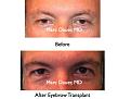 Click image for larger version

Name:	Hair Transplant Slides6.181.jpg
Views:	415
Size:	61.4 KB
ID:	467380