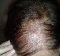 Click image for larger version

Name:	pre hair surgery.jpg
Views:	260
Size:	77.3 KB
ID:	467515