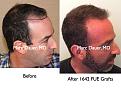 Click image for larger version

Name:	Hair Transplant Slides3.200.jpg
Views:	713
Size:	83.7 KB
ID:	467679