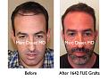 Click image for larger version

Name:	Hair Transplant Slides3.199.jpg
Views:	736
Size:	79.5 KB
ID:	467680