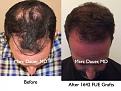 Click image for larger version

Name:	Hair Transplant Slides3.202.jpg
Views:	510
Size:	89.8 KB
ID:	467681