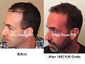 Click image for larger version

Name:	Hair Transplant Slides3.201.jpg
Views:	633
Size:	80.1 KB
ID:	467682