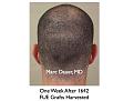 Click image for larger version

Name:	Hair Transplant Slides3.203.jpg
Views:	425
Size:	61.8 KB
ID:	467683