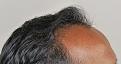 Click image for larger version

Name:	jh 8 months post-op R profile (1).jpg
Views:	311
Size:	92.8 KB
ID:	467700