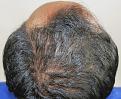 Click image for larger version

Name:	jh 8 months post-op crown (2).jpg
Views:	327
Size:	93.5 KB
ID:	467701