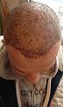 Click image for larger version

Name:	post operation 3 days later.JPG
Views:	676
Size:	88.2 KB
ID:	467729