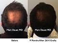 Click image for larger version

Name:	Hair Transplant Slides5.217.jpg
Views:	367
Size:	74.0 KB
ID:	467854