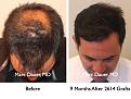 Click image for larger version

Name:	Hair Transplant Slides5.216.jpg
Views:	359
Size:	79.3 KB
ID:	467855