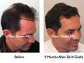 Click image for larger version

Name:	Hair Transplant Slides5.215.jpg
Views:	680
Size:	73.3 KB
ID:	467856